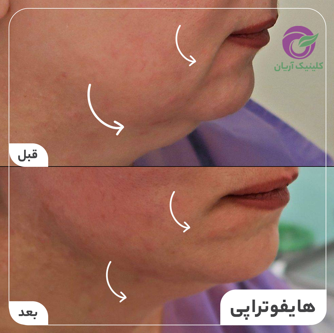 گالری هایفوتراپی